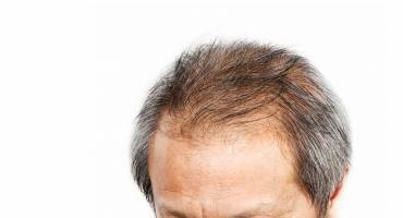 Haaruitval en haargroeiprobleem